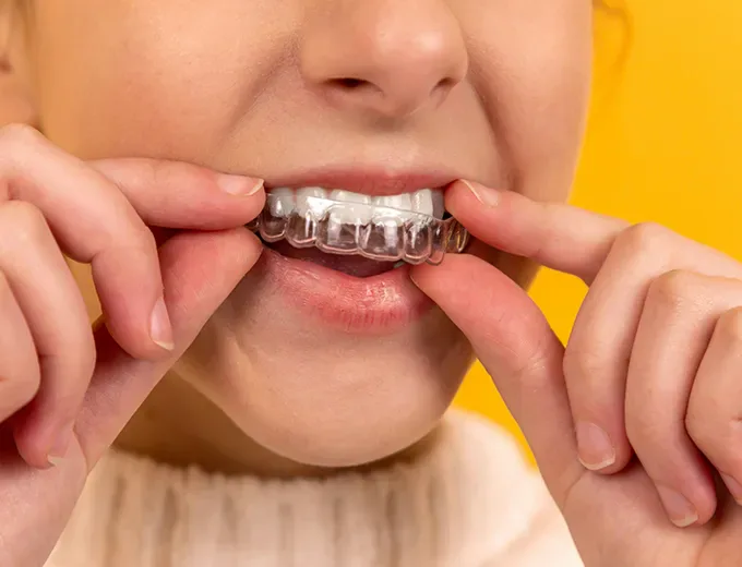 Invisalign clear aligner treatment at Hulme Court Dental Mount Pleasant