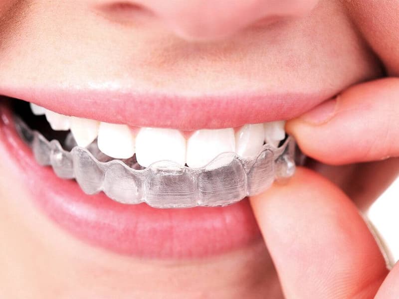 Invisalign and denture treatment options demonstrated on dental model
